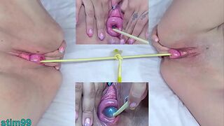 Prolapsed Cervix Lesbians at the same time